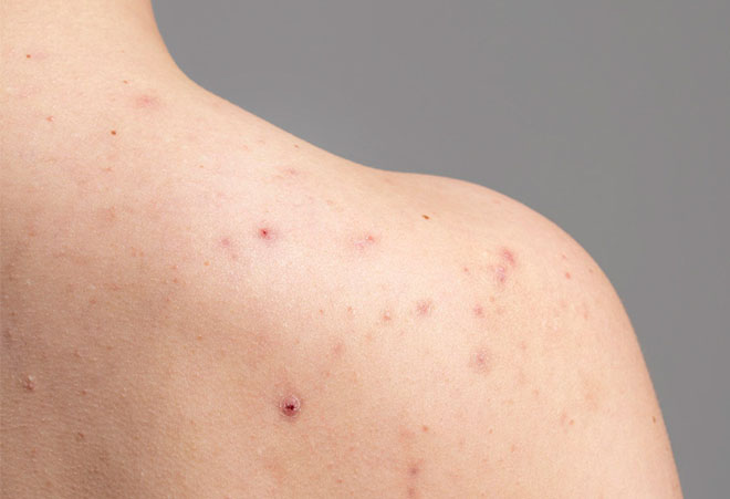 Mozolji na hrbtu: Kaj jih povzroča in kako jih odpraviti?